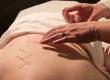 Acupuncture and Acupressure for Fibromyalgia Relief