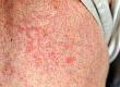 Skin Rashes and Fibromyalgia Syndrome