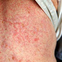 Skin Rashes Fibromyalgia Syndrome Dry
