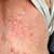 Skin Rashes and Fibromyalgia Syndrome