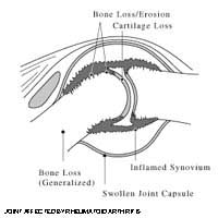 Fibromyalgia Syndrome Systemic Lupus